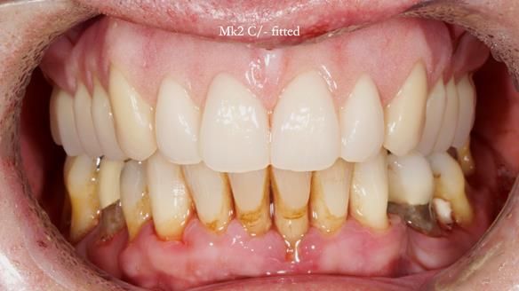 Newsletter 77: Jeremy’s case – immediate complete upper denture