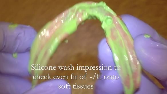 Managing poor implant positioning with complete dentures and Locator attachments - full protocol Newsletter 41