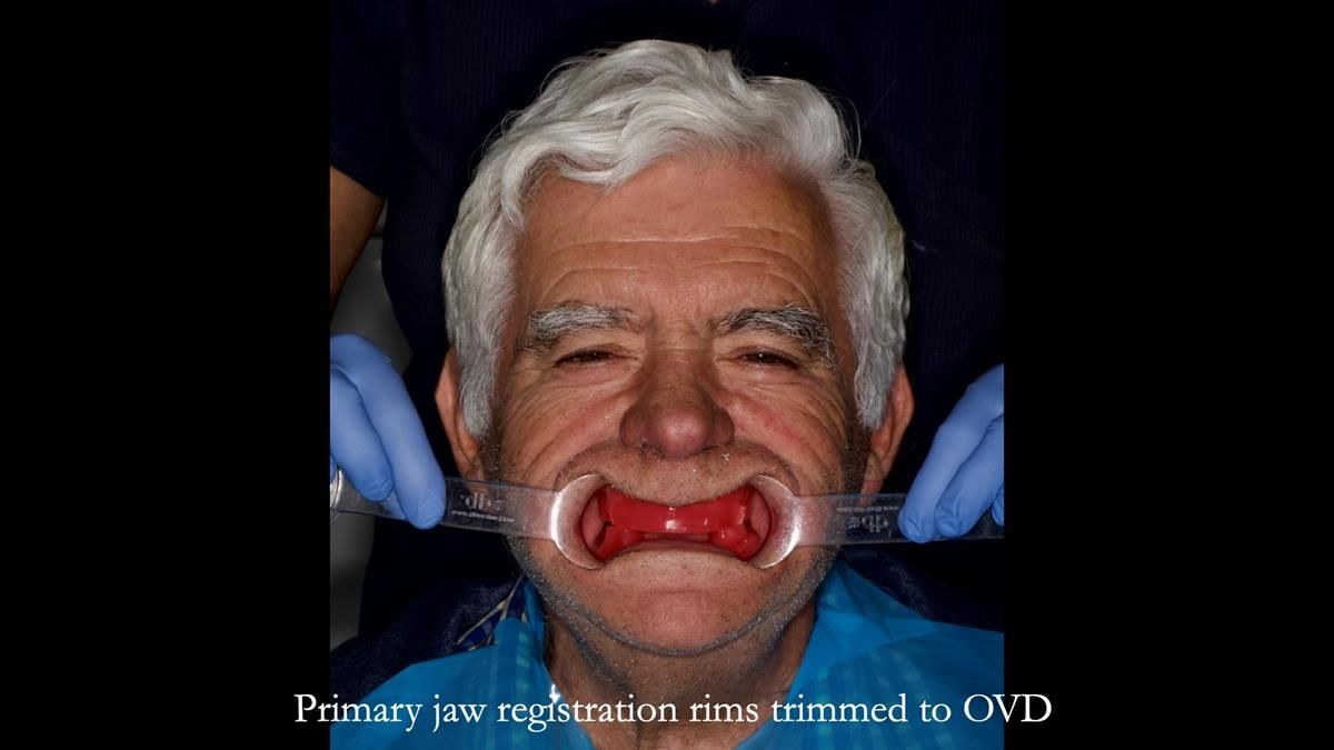Fin’s Newsletter 88 — Complete dentures - full protocol… he rearranged his own teeth!