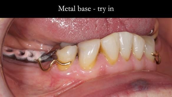 Eileen's transformation with upper and lower RPDs of Scandinavian hygienic design FULL PROTOCOL