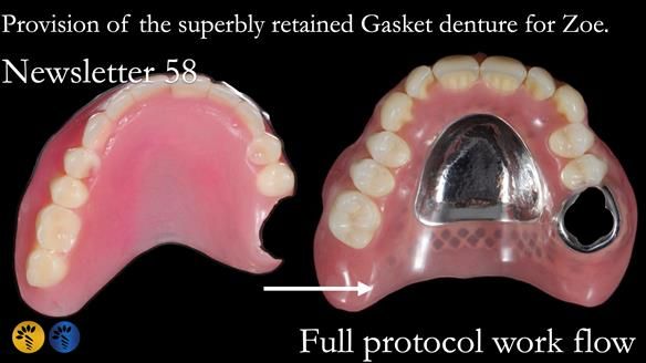 Finlay's Newsletter 58 Gasket upper partial denture for Zoe