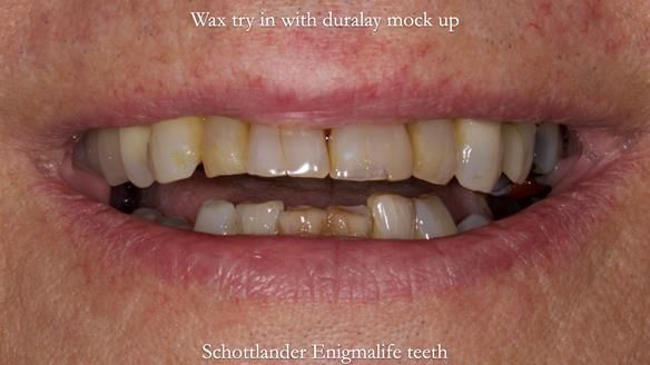 Finlay's Newsletter 64 case study - provision of a Kennedy class 2 metal based Scandinavian RPD for Ian