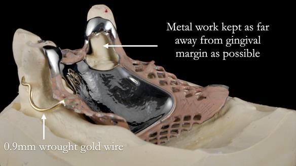 Finlay's Newsletter 59 Ultra hard partial dentures made for Gill