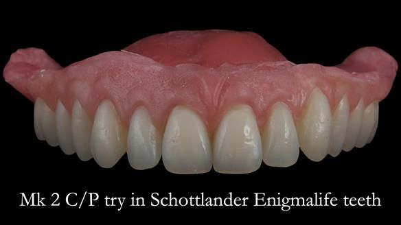Newsletter 52 Managing Jo’s failing dentition with extractions and Mk 1/Mk 2 complete upper dentures and lower partial dentures FULL PROTOCOL