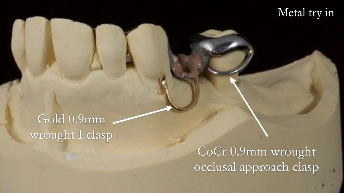 Newsletter 89 – Simon: A Challenging Kennedy Class II Division 1 Upper CoCr Partial Denture with a High Smile Line