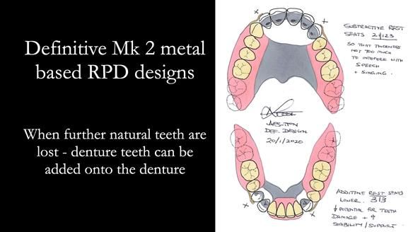 Finlay's Case Study Newsletter 40 - Immediate Mk 1 RPD to Definitive Mk 2 RPD - full protocol