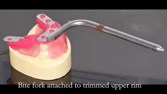 Newsletter 55 Provision of metal based partial dentures for Zephyrine with a repaired cleft lip and palate