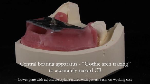 Finlay's Newsletter 59 Ultra hard partial dentures made for Gill