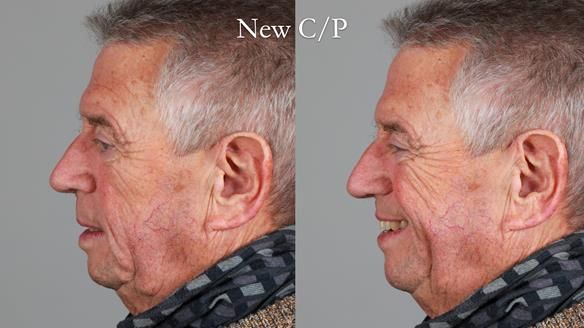 Newsletter 54 case presentation upper complete denture and lower Scandinavian designed hygienic partial denture for David