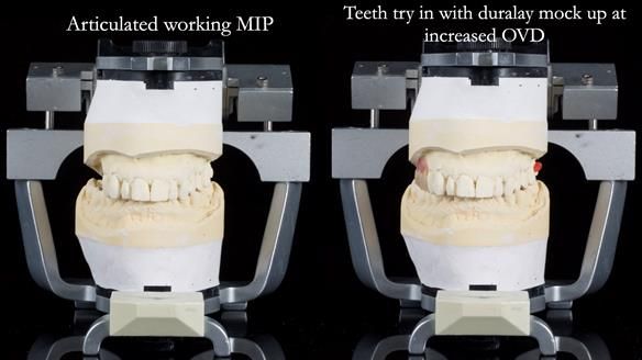 Finlay's Newsletter 64 case study - provision of a Kennedy class 2 metal based Scandinavian RPD for Ian