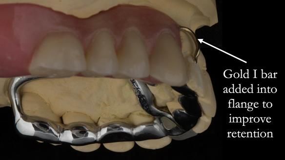 Newsletter 51 Managing Anne’s failing dentition with distal extension base RPD/Splint FULL PROTOCOL
