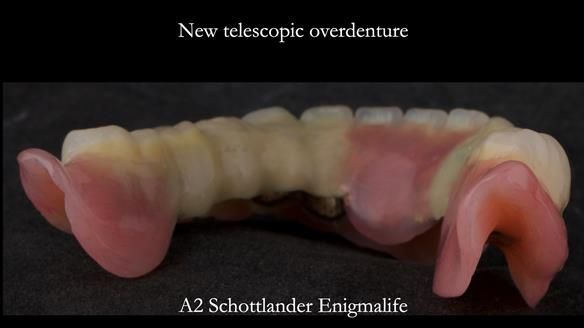 Newsletter 76: Jackie’s case – Telescopic overdenture & precision RPD (the tricky truth!)