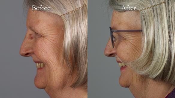 Newsletter 82 Mary - A complete upper and a one-tooth gasket denture