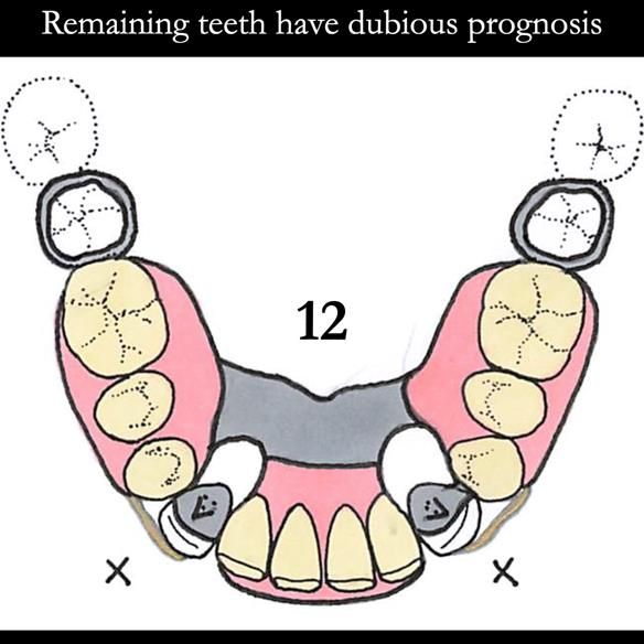 Universal Scandinavian partial denture designs