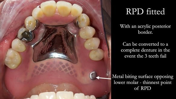Finlay's Newsletter 59 Ultra hard partial dentures made for Gill