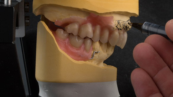 Figure 29 Inflamed soft tissue indicated on the cast