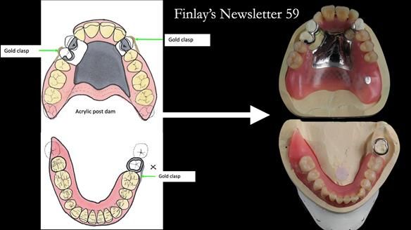 Finlay's Newsletter 59 Ultra hard partial dentures made for Gill