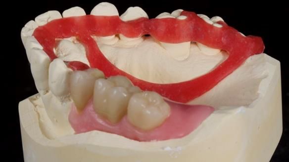 Finlay's Newsletter 64 case study - provision of a Kennedy class 2 metal based Scandinavian RPD for Ian