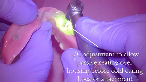 Managing poor implant positioning with complete dentures and Locator attachments - full protocol Newsletter 41