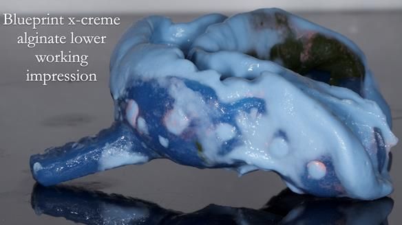 Newsletter 55 Provision of metal based partial dentures for Zephyrine with a repaired cleft lip and palate