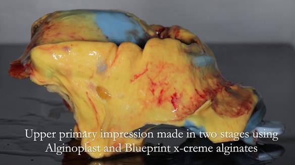 Finlay's Newsletter 62 provision of extractions and metal based complete dentures for Rafique