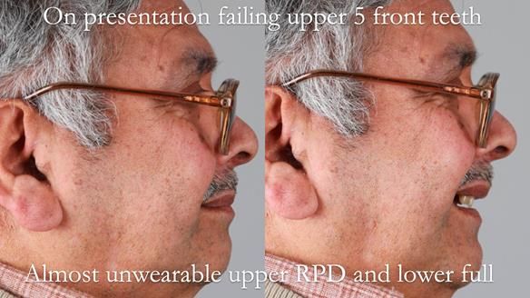 Finlay's Newsletter 62 provision of extractions and metal based complete dentures for Rafique