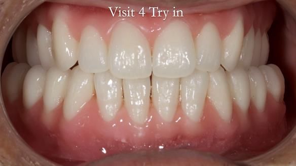 Managing poor implant positioning with complete dentures and Locator attachments - full protocol Newsletter 41