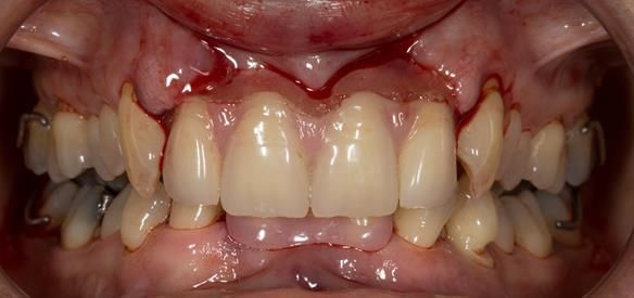 Figure 42 immediate denture fitted with patient in intercuspal position