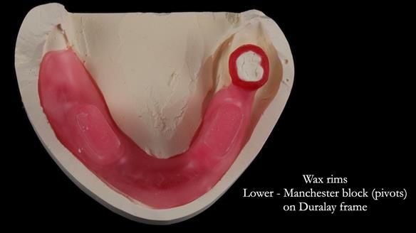 Finlay's Newsletter 59 Ultra hard partial dentures made for Gill