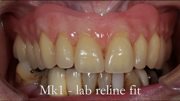 Figure 55 Laboratory relined Mk 1fitted - note the periphery