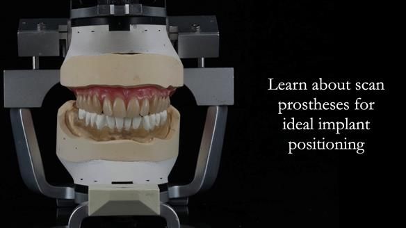 Finlay's Newsletter 59 Ultra hard partial dentures made for Gill