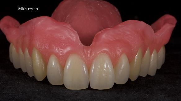 Newsletter 77: Jeremy’s case – immediate complete upper denture