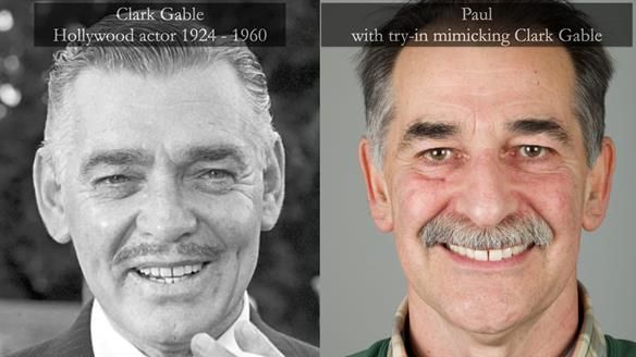 Newsletter 78: What do Clark Gable and a Locator® overdenture have in common?