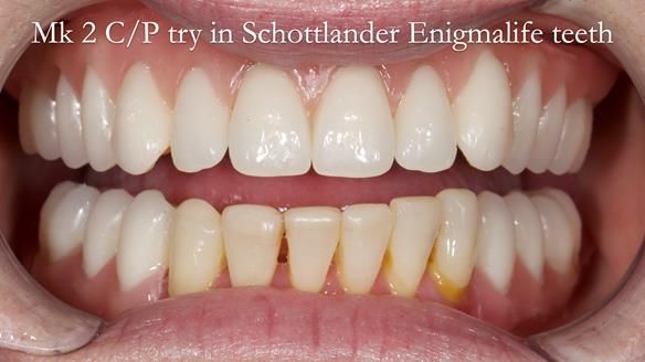 Newsletter 52 Managing Jo’s failing dentition with extractions and Mk 1/Mk 2 complete upper dentures and lower partial dentures FULL PROTOCOL