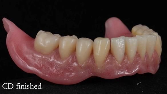 Finlay's Newsletter 62 provision of extractions and metal based complete dentures for Rafique