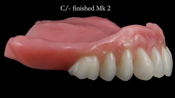 Newsletter 52 Managing Jo’s failing dentition with extractions and Mk 1/Mk 2 complete upper dentures and lower partial dentures FULL PROTOCOL