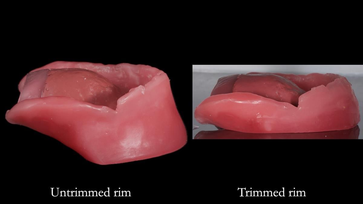 Fin’s Newsletter 88 — Complete dentures - full protocol… he rearranged his own teeth!