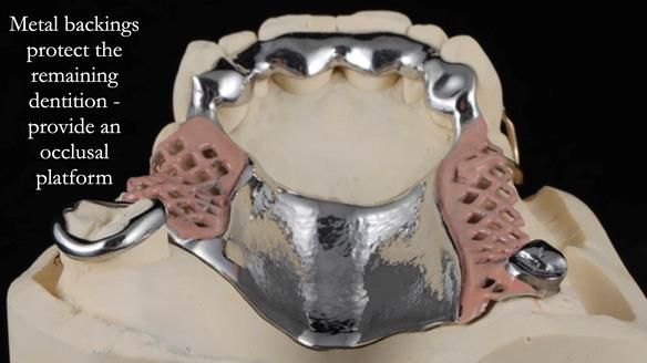 Finlay's Newsletter 60 Sylvia's upper Kennedy Class 2 Mod 1 metal based upper RPD