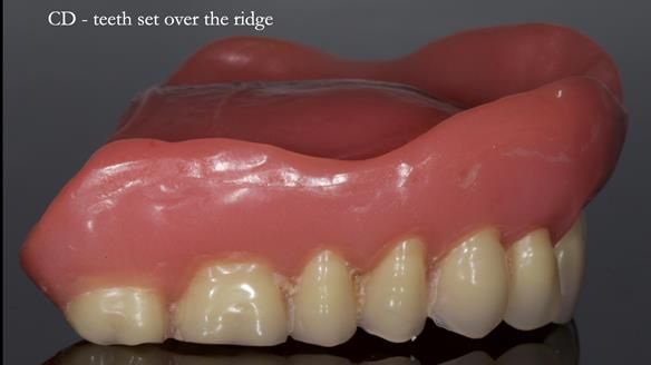 Newsletter 83: Sheila’s Complete Denture Success