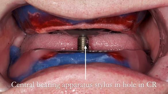 Newsletter 57 showcases the making and fitting process of implant-supported complete dentures for Alisdair