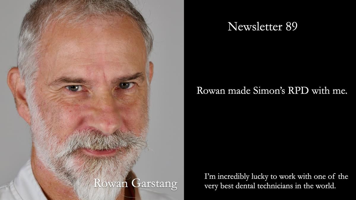 Newsletter 89 – Simon: A Challenging Kennedy Class II Division 1 Upper CoCr Partial Denture with a High Smile Line