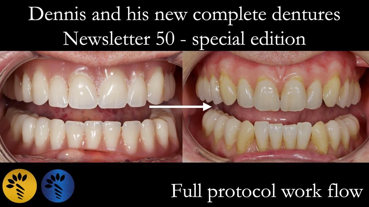 Newsletter 50 Special edition Complete Dentures FULL PROTOCOL