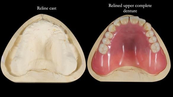 Newsletter 78: What do Clark Gable and a Locator® overdenture have in common?