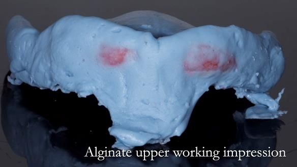 Managing poor implant positioning with complete dentures and Locator attachments - full protocol Newsletter 41