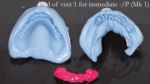 Newsletter 54 case presentation upper complete denture and lower Scandinavian designed hygienic partial denture for David