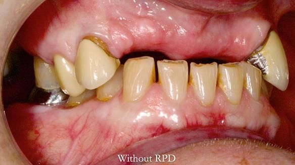 Newsletter 81 - Pam’s Story — how a partial denture changed her life (+ live walkthrough this Thursday)