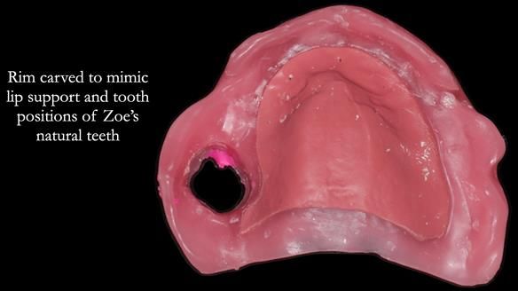 Finlay's Newsletter 58 Gasket upper partial denture for Zoe