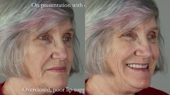 Newsletter 70 Complete Denture Treatment for Kate: A Case Study on Natural-Looking Dentures and Implant-Supported Overdentures