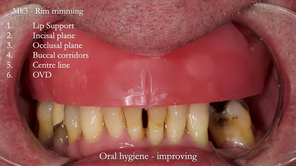 Newsletter 77: Jeremy’s case – immediate complete upper denture
