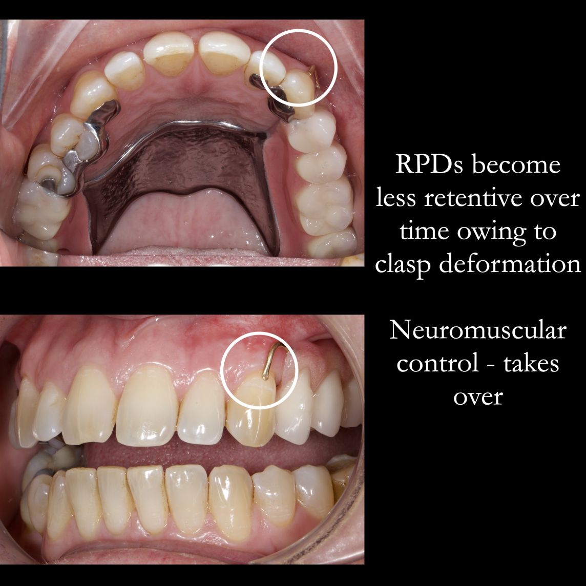 Removable partial dentures become less retentive over time – “less grippy”